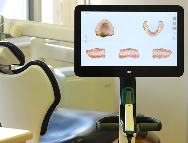 Digitale Abdrucknahme mit einem intraoralen Scanner